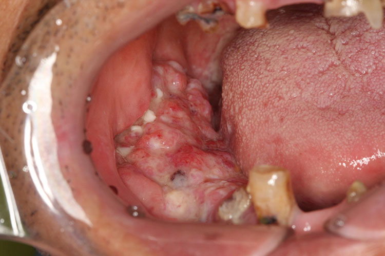 牙龈鳞状细胞癌-黏膜出血图